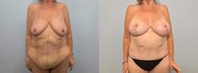 Mommy Makeover Before & After Gallery - Patient 47253843 - Image 1