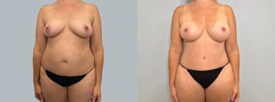 Mommy Makeover Before & After Gallery - Patient 47253855 - Image 1