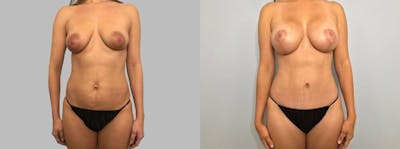 Mommy Makeover Before & After Gallery - Patient 47253856 - Image 1