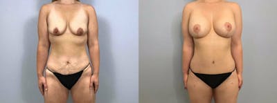 Mommy Makeover Before & After Gallery - Patient 47253864 - Image 1