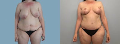Mommy Makeover Before & After Gallery - Patient 47253870 - Image 1