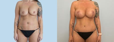 Mommy Makeover Before & After Gallery - Patient 47253876 - Image 1