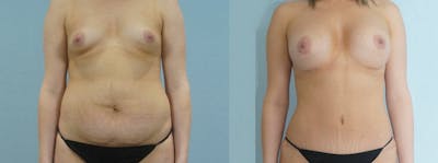 Mommy Makeover Before & After Gallery - Patient 47253879 - Image 1