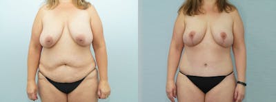 Mommy Makeover Before & After Gallery - Patient 47253884 - Image 1