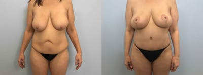 Mommy Makeover Before & After Gallery - Patient 47253899 - Image 1