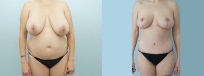 Mommy Makeover Before & After Gallery - Patient 47253902 - Image 1