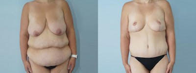 Mommy Makeover Before & After Gallery - Patient 47253911 - Image 1