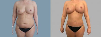 Mommy Makeover Before & After Gallery - Patient 47253913 - Image 1
