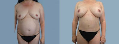 Mommy Makeover Before & After Gallery - Patient 47253921 - Image 1