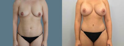 Mommy Makeover Before & After Gallery - Patient 47253933 - Image 1