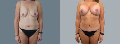 Mommy Makeover Before & After Gallery - Patient 47253935 - Image 1