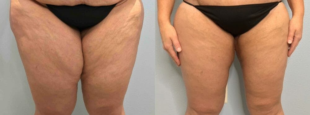 Thigh Lift