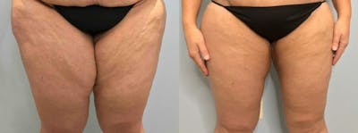 Thigh Lift Before & After Gallery - Patient 47253957 - Image 1