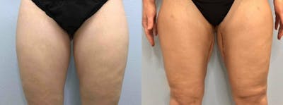 Thigh Lift Before & After Gallery - Patient 47253958 - Image 1