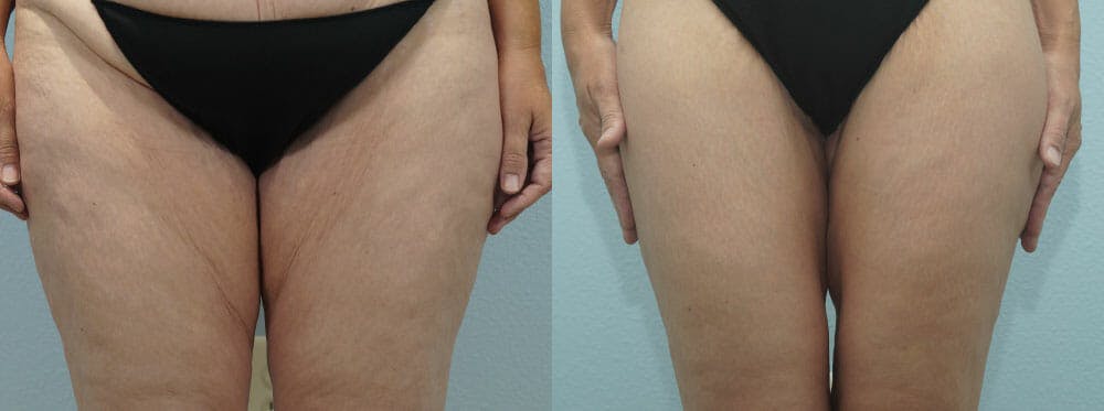 Thigh Lift