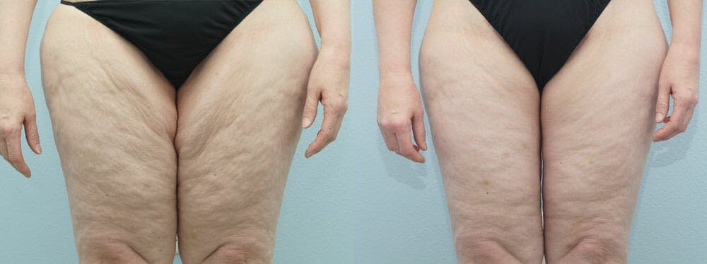 Thigh Lift