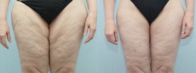 Thigh Lift Gallery - Patient 47253965 - Image 1