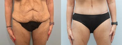 Tummy Tuck Before & After Gallery - Patient 47253975 - Image 1
