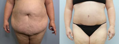 Tummy Tuck Before & After Gallery - Patient 47253980 - Image 1