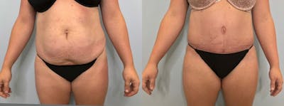 Tummy Tuck Before & After Gallery - Patient 47253984 - Image 1