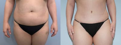 Tummy Tuck Before & After Gallery - Patient 47253990 - Image 1