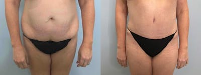 Tummy Tuck Before & After Gallery - Patient 47254000 - Image 1