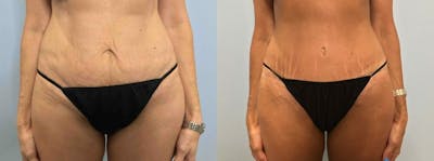 Tummy Tuck Before & After Gallery - Patient 47254006 - Image 1