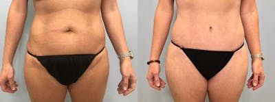 Tummy Tuck Before & After Gallery - Patient 47254019 - Image 1