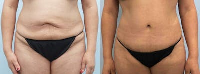 Tummy Tuck Before & After Gallery - Patient 47254032 - Image 1