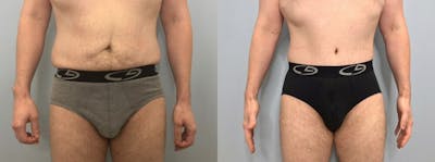 Tummy Tuck Before & After Gallery - Patient 47254038 - Image 1