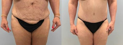 Tummy Tuck Before & After Gallery - Patient 47254039 - Image 1