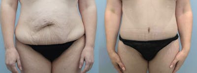 Tummy Tuck Gallery - Patient 47254049 - Image 1