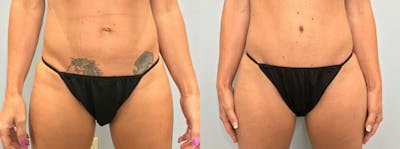 Tummy Tuck Before & After Gallery - Patient 47254063 - Image 1