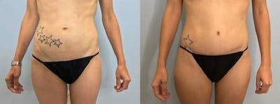 Tummy Tuck Before & After Gallery - Patient 47254067 - Image 1