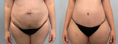 Tummy Tuck Before & After Gallery - Patient 47254070 - Image 1