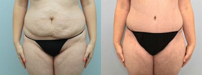 Tummy Tuck Before & After Gallery - Patient 47254071 - Image 1