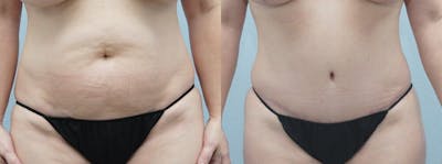 Tummy Tuck Before & After Gallery - Patient 47254074 - Image 1