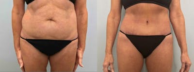Tummy Tuck Before & After Gallery - Patient 47254077 - Image 1