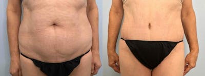 Tummy Tuck Before & After Gallery - Patient 47254079 - Image 1