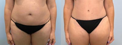 Tummy Tuck Before & After Gallery - Patient 47254087 - Image 1