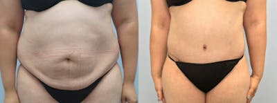 Tummy Tuck Before & After Gallery - Patient 47254093 - Image 1