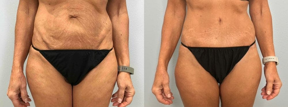 Tummy Tuck