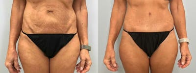 Tummy Tuck Before & After Gallery - Patient 47254099 - Image 1