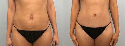 Tummy Tuck Before & After Gallery - Patient 47254153 - Image 1