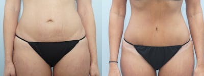 Tummy Tuck Before & After Gallery - Patient 47254372 - Image 1