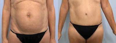 Tummy Tuck Before & After Gallery - Patient 47254507 - Image 1
