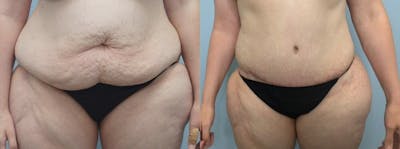 Tummy Tuck Before & After Gallery - Patient 47254516 - Image 1