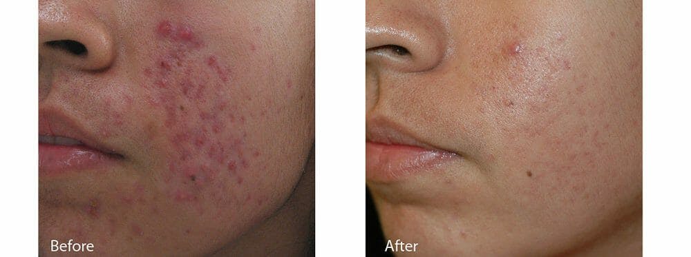 Acne & Acne Scars