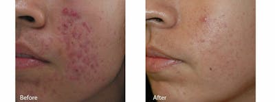 Acne Before & After Gallery - Patient 47432393 - Image 1
