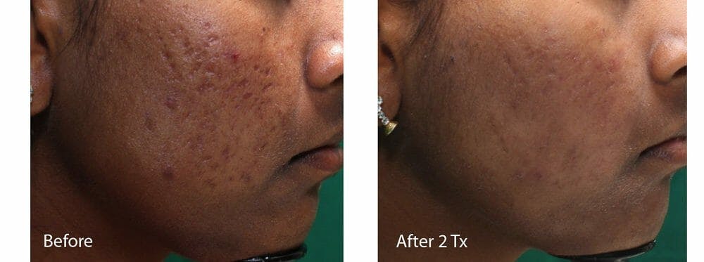 Acne & Acne Scars